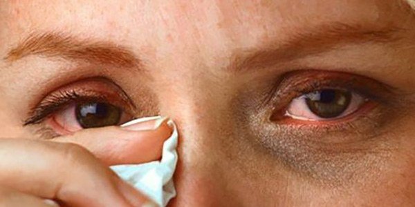 раздражение глаз при аллергии на воду