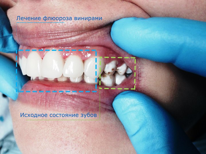 Лечение флюорозных зубов винирами