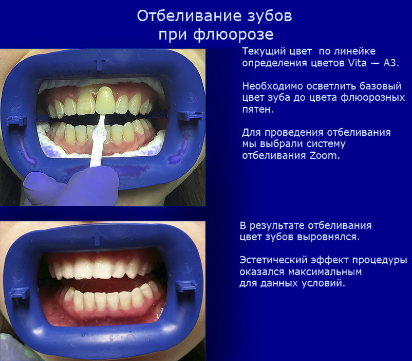 Отбеливание зубов при флюорозе