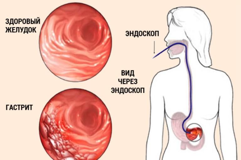 Гастрит