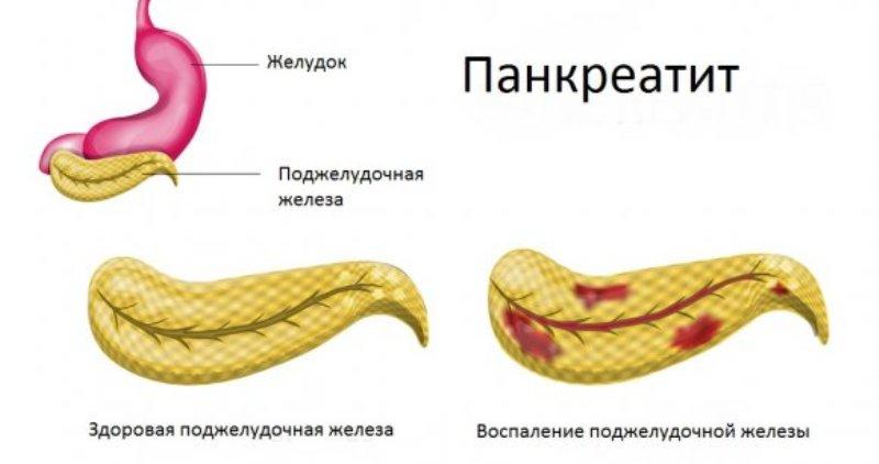 Панкреатит